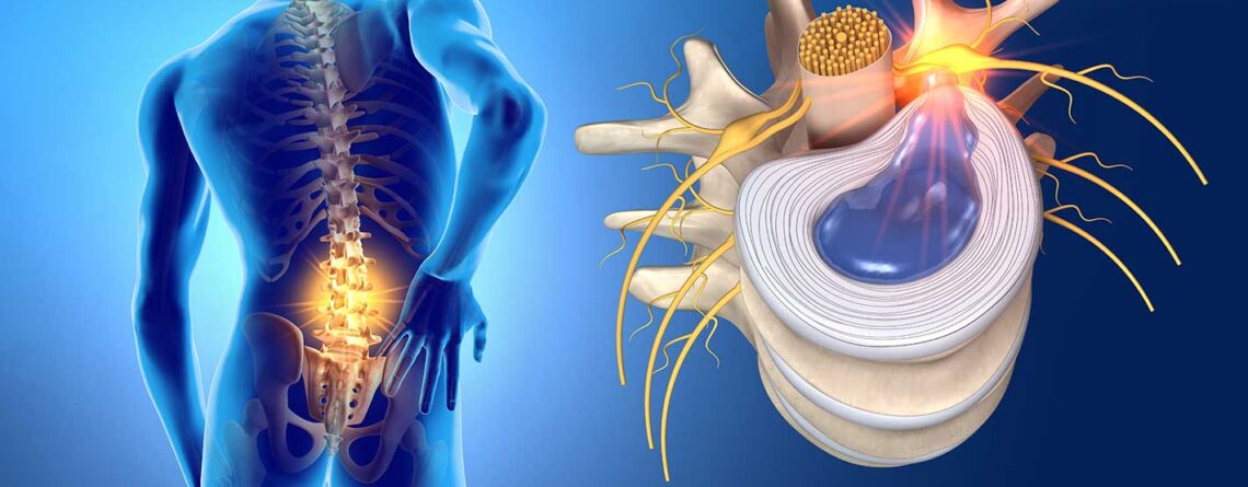 Massagesessel bei Bandscheibenvorfall: Wichtige Hinweise &