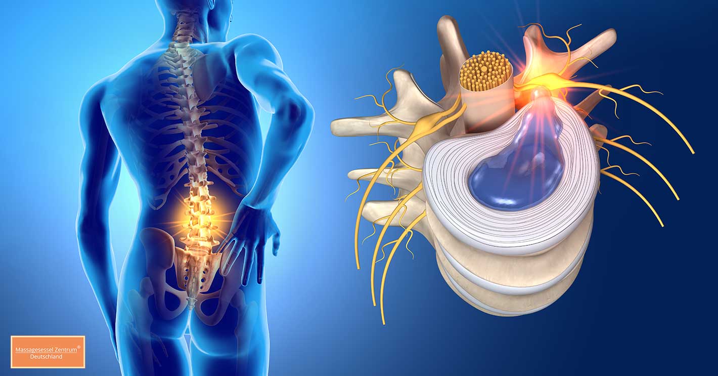 Massagesessel bei Bandscheibenvorfall: Wichtige Hinweise &